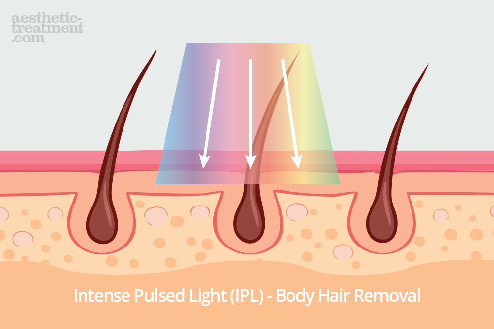 ipl-intense-pulsed-light-hair-removal-treatment-illustration