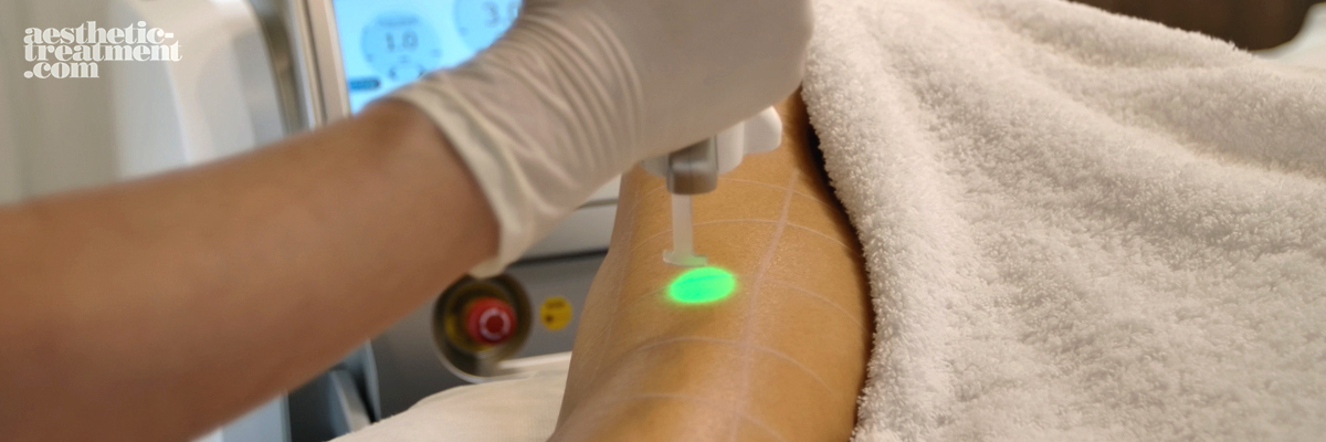 lutronic-clarity-laser-varicose-spider-vein-legs-aesthetic-treatment