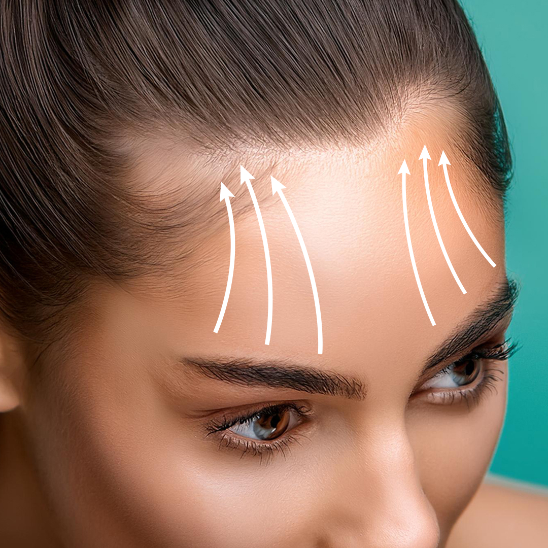 botox brow lift botulinum toxin procedure overview