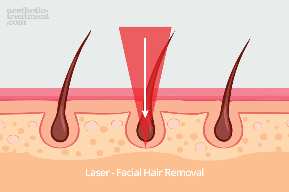 how-laser-hair-removal-treatment-works