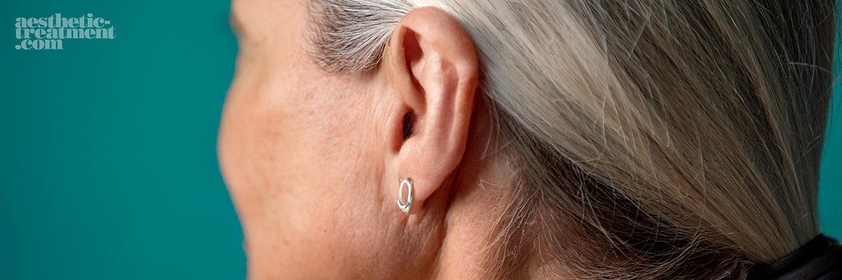 ear-lobes-augmentation-aesthetic-treatment-options